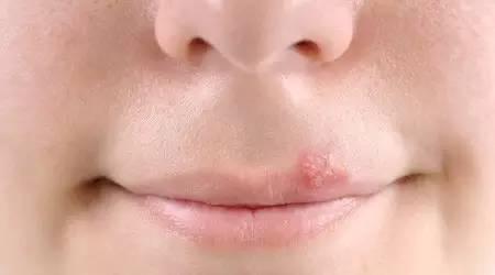 孕晚期感染x病毒对胎儿有影响吗,孕妇感染igm病毒是怎么感染的