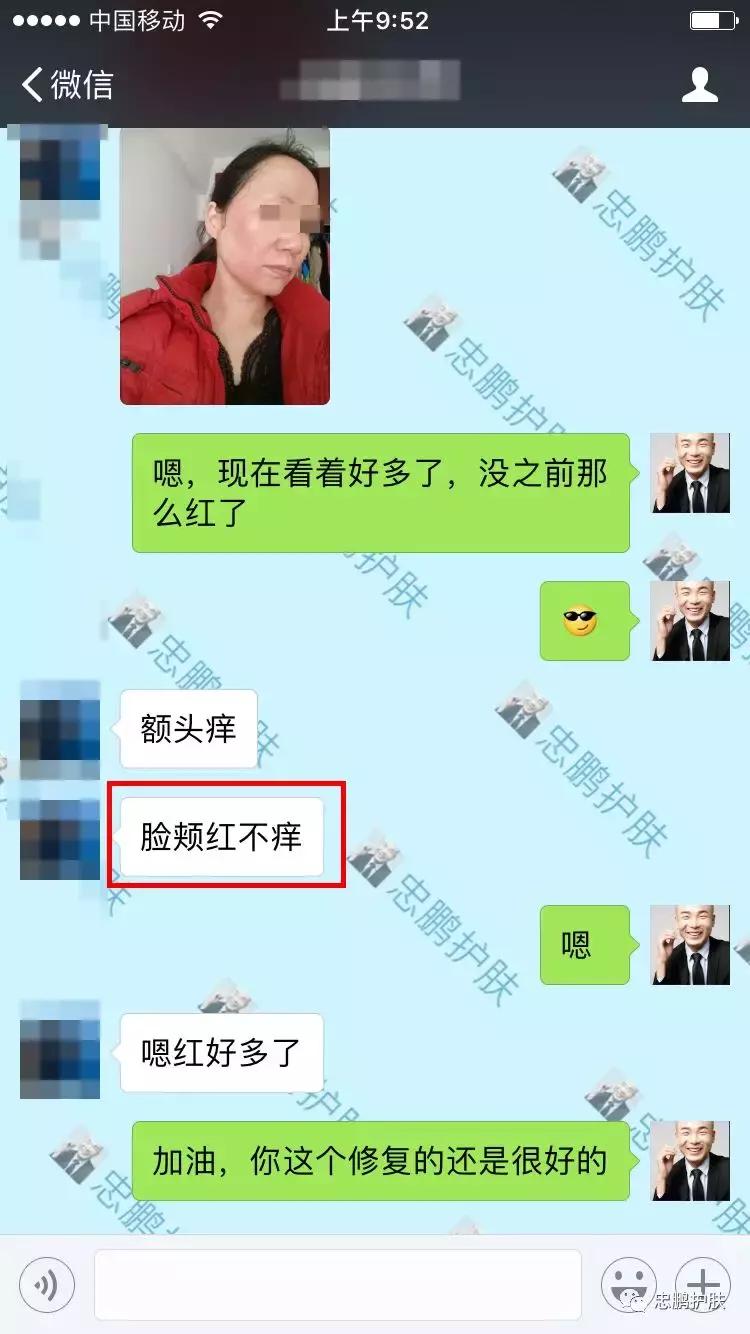 激素脸发红发热脱皮怎么办呢,激素脸为什么会扩散到脖子上代谢