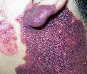 面部鲜红斑痣对求职影响,红胎记和鲜红斑痣能消失吗