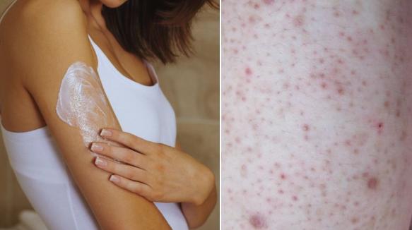 脸上莫名的小颗粒到底是什么？皮肤专家教你护肤