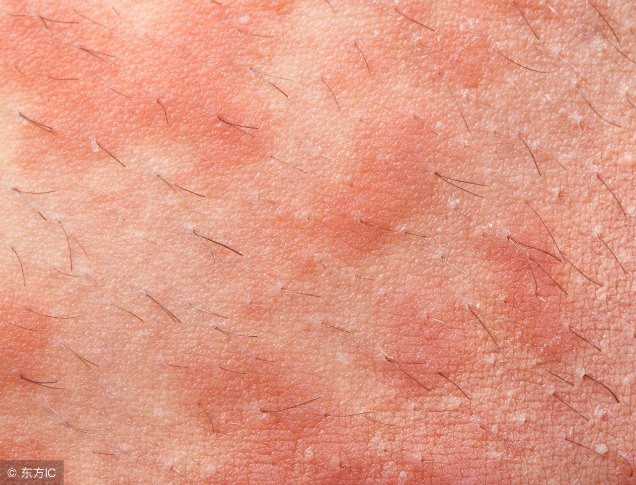 荨麻疹患者特别需要注意哪些饮食,患有荨麻疹时在饮食上应注意哪些