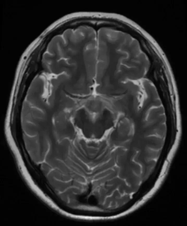 复旦大学附属中山医院放射科病例讨论（八十四）