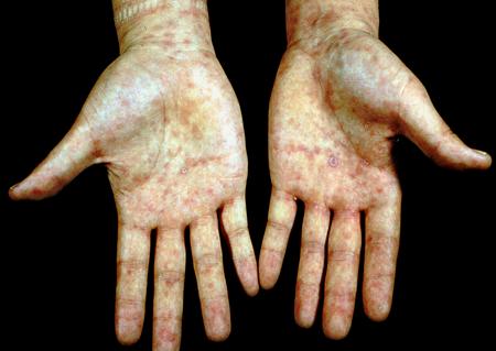 艾滋病可怕吗,艾滋病真的特别容易传染吗