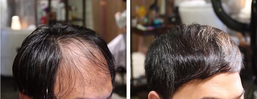 圆脸发际线高的男生适合什么发型,发际线高头发稀少发型男