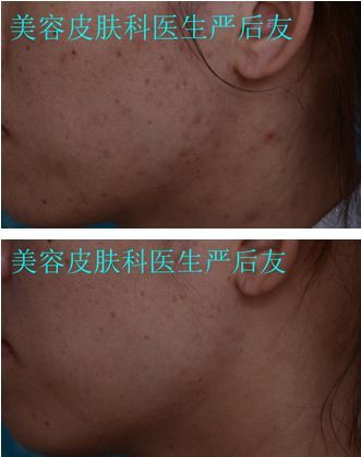 皮肤科修复痘坑大全,痘印痘坑修复皮肤科医生