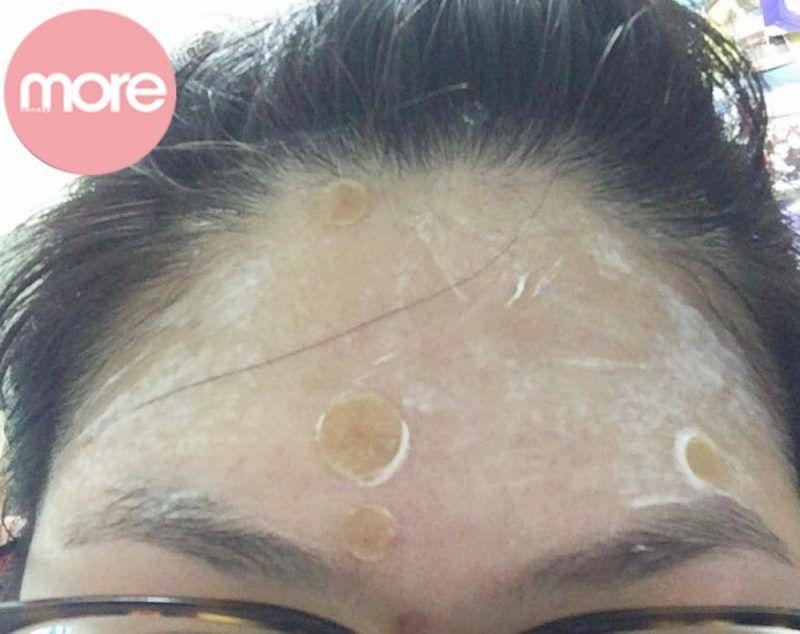 娥罗纳英祛痘印效果好吗,娥罗纳英软膏可以去黑头吗