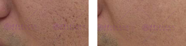 快速祛痘印小窍门真的管用,教你几招祛痘印的最快方法