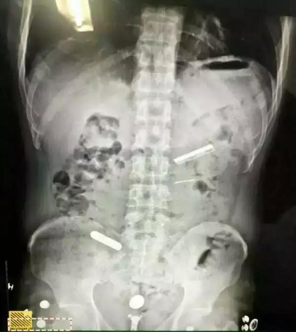 吸毒人吞刀片是怎么回事,吸毒吞食异物为什么躲避惩罚