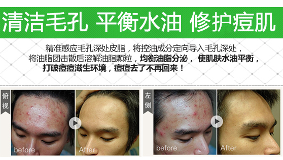 男士祛痘祛痘印小窍门,男士怎么祛痘祛痘印效果好