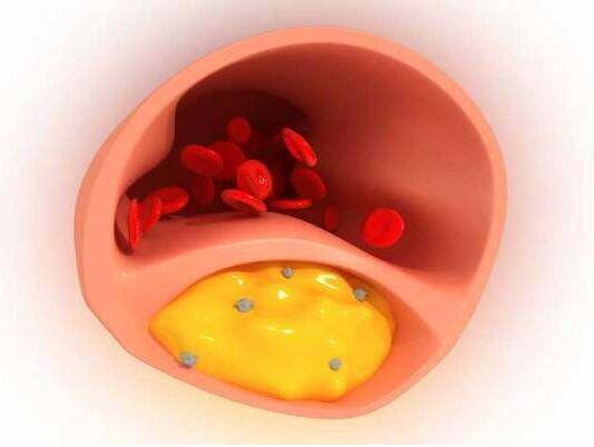 甘油三酯高为什么会造成动脉硬化,动脉硬化指数和甘油三酯高吃什么