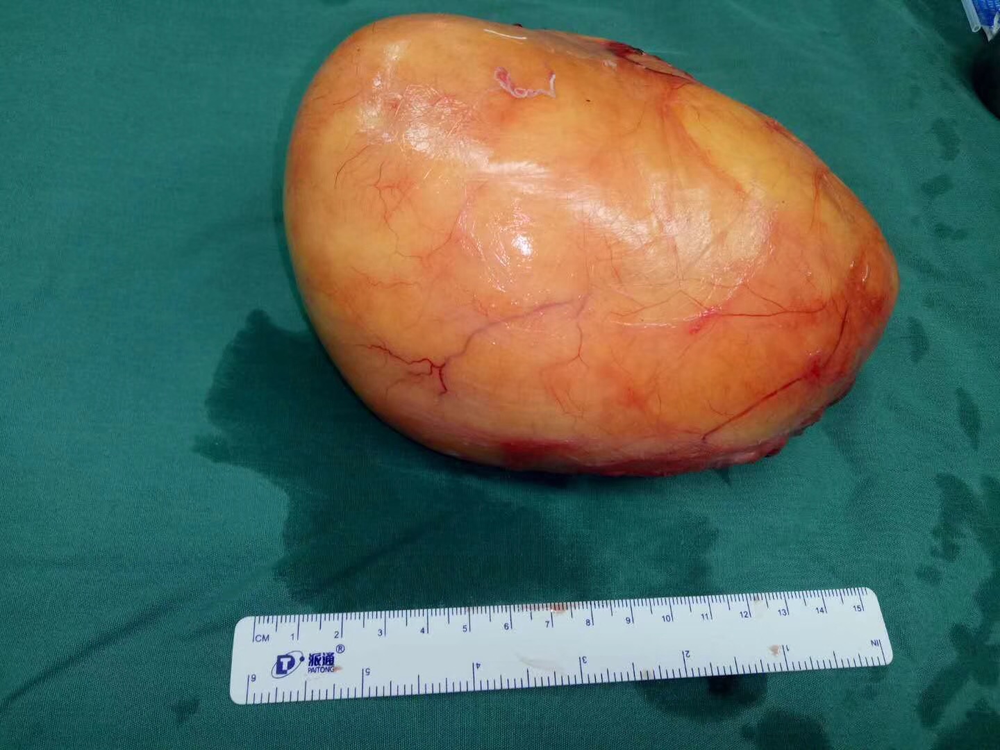 8斤重！堪比巨婴的脂肪瘤在手臂上挂了近30年！