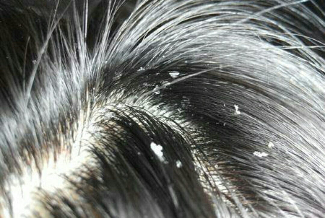 刚洗完头发头皮就抠出白泥怎么办,头发隔夜出油是什么原因