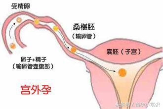 孕早期出血要注意宫外孕吗,孕早期出血需要立即就医吗