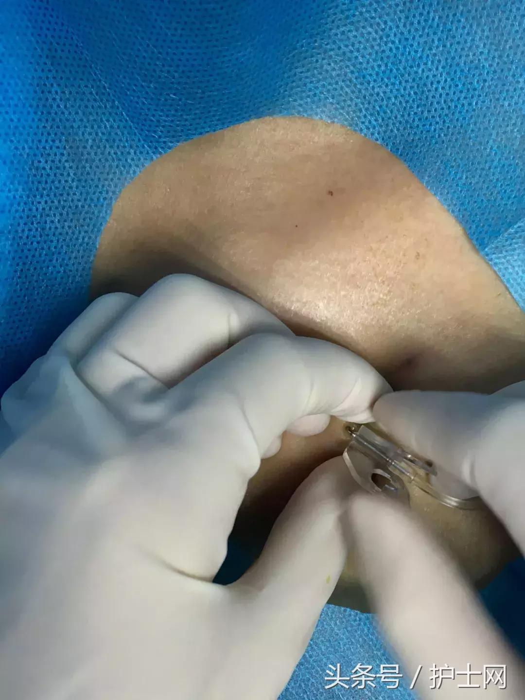 输液港扎针最全示范,输液港拔针的正确方法视频教程