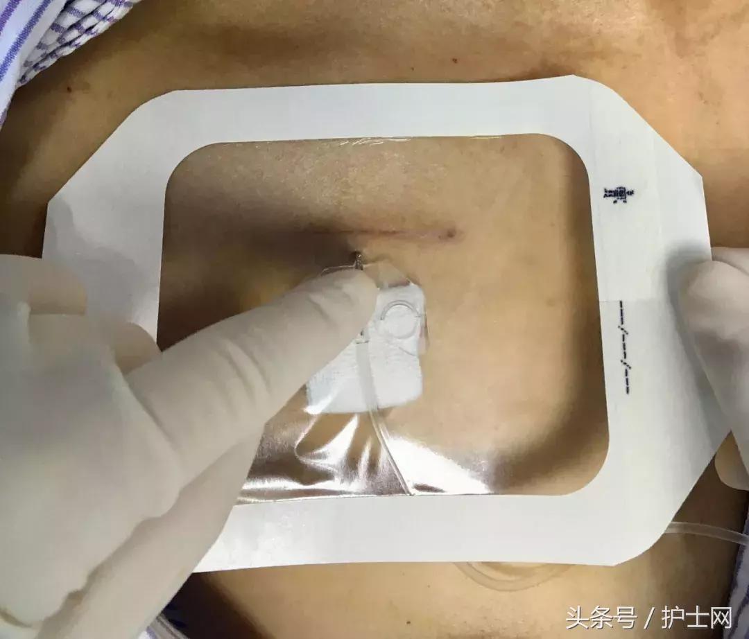 输液港扎针最全示范，再也不怕病人说技术不到位了