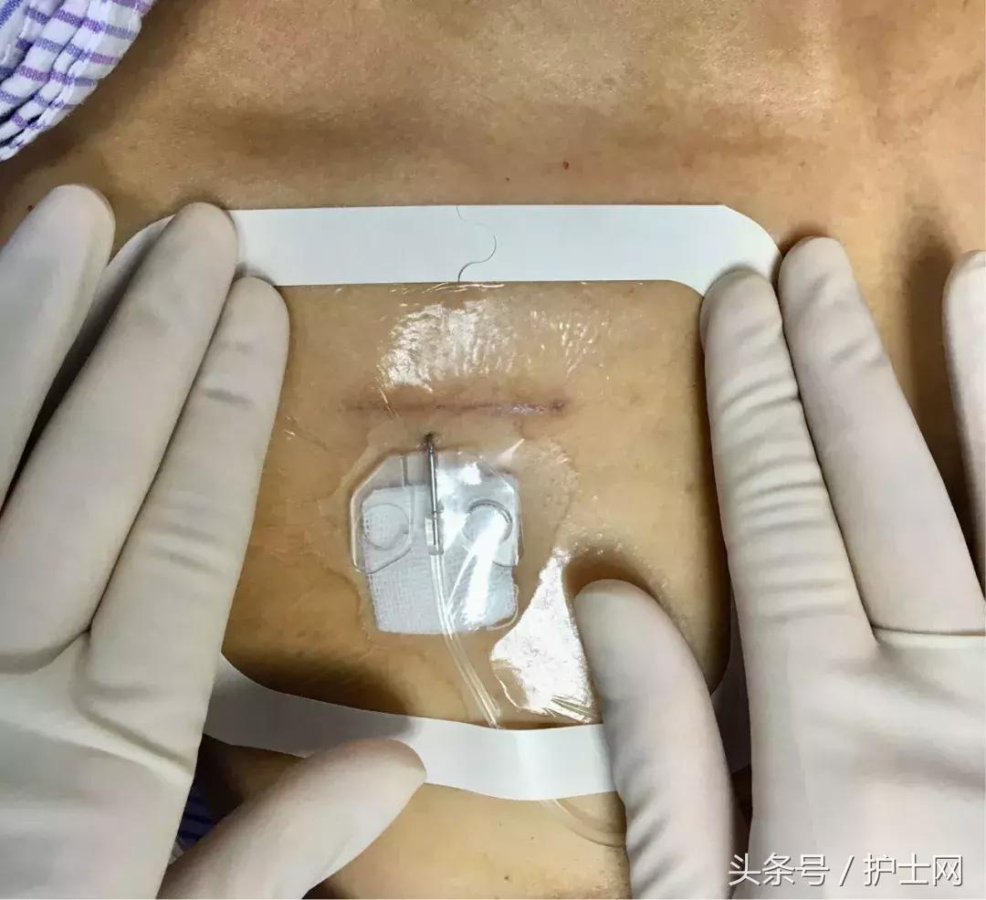 输液港扎针最全示范,输液港拔针的正确方法视频教程