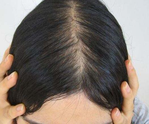 头发稀少想要养出浓密秀发，试试这几招！