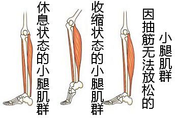 睡觉腿抽筋怎么办快速缓解,为什么会腿抽筋怎么治疗