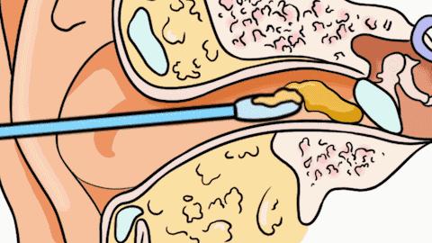 25万儿童因一根棉签进急诊！身上3个部位，别瞎碰！