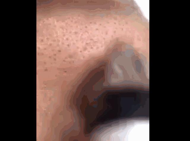 蔡徐坤、Angelababy都根治不掉的黑头，微商神器能去除？