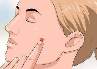 脸上长闭口怎么办教你正确祛闭口,脸上反复长闭口的原因和解决方法