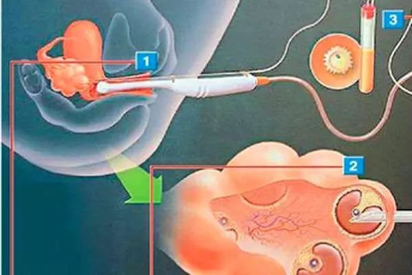 女大学生捐卵20颗,女孩捐卵20颗死亡