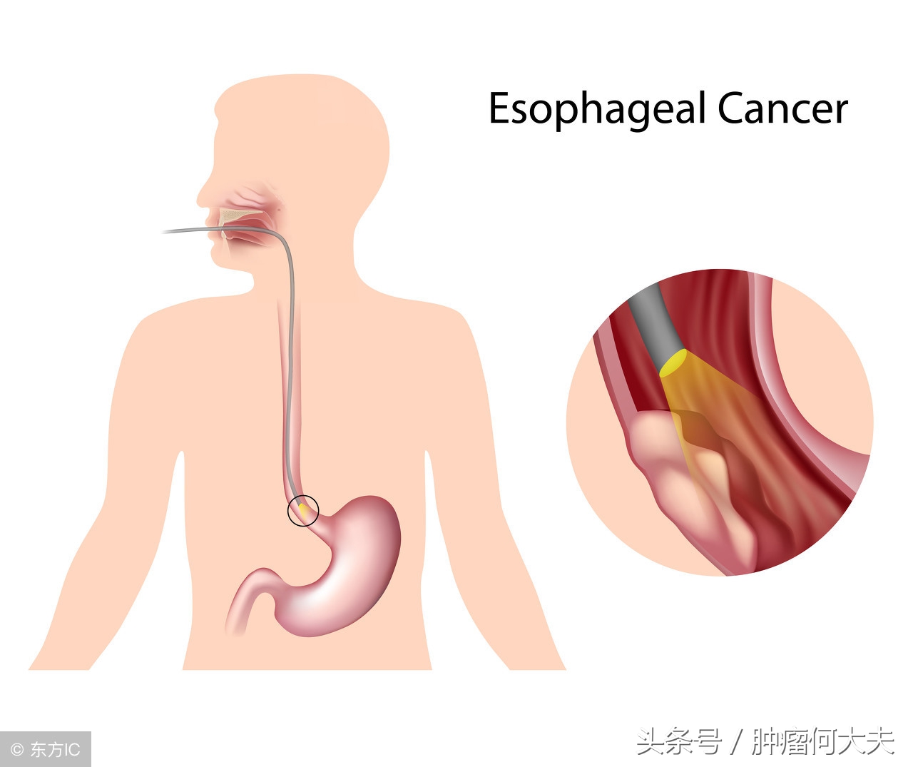 食管癌发病率高的地方,食管癌恶性程度最高的是