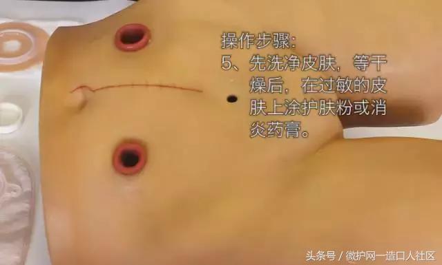造口护理小窍门视频,更换造口护理技术操作流程