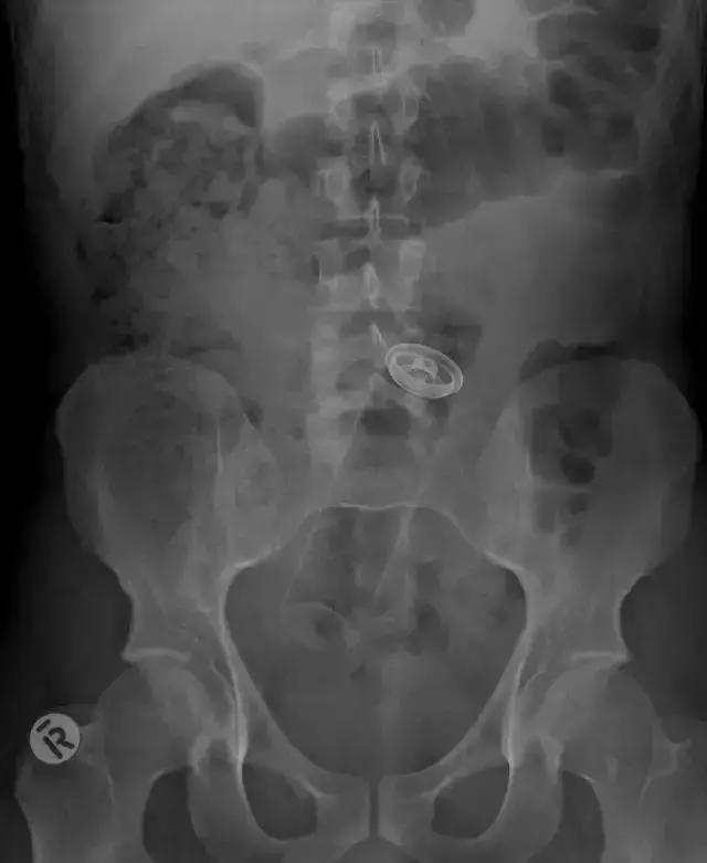 盘点X光透视下的人体异物,看着都痛!