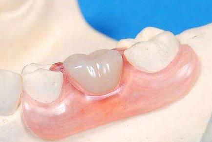 牙龈萎缩露出牙根还能恢复吗,牙龈萎缩牙齿根部会疼吗