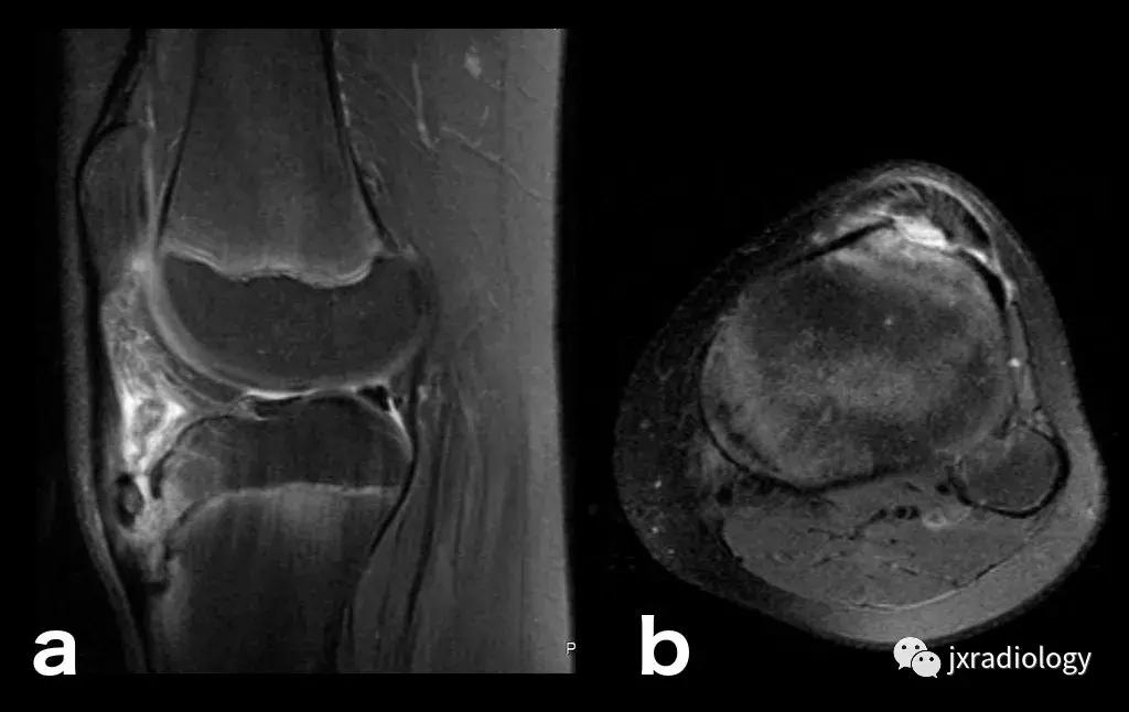 膝关节骨髓水肿疼痛特点,膝关节骨髓水肿的临床表现