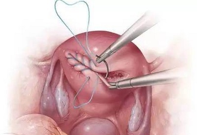 疤痕子宫可以生三胎剖宫产吗,一次剖宫产永远剖宫产吗