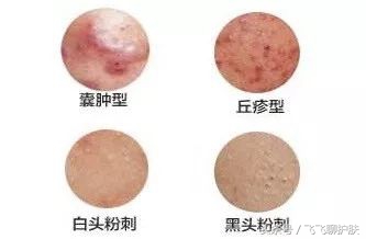 只有长痘才知道痘痘有多难治,要知道痘痘的根源