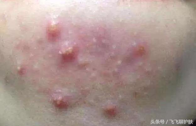 只有长痘才知道痘痘有多难治,要知道痘痘的根源