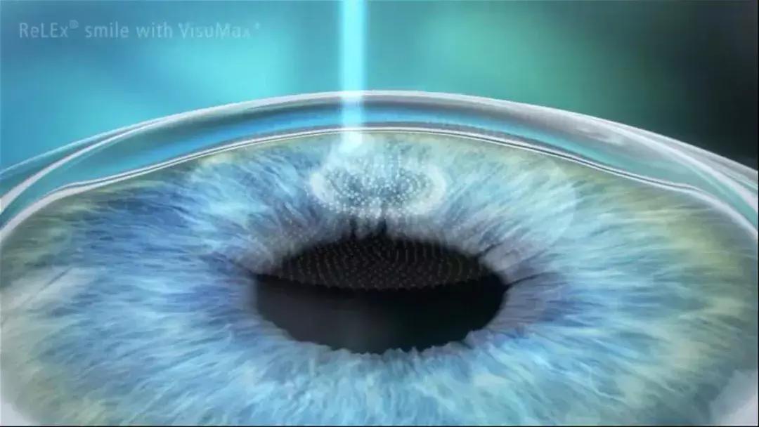 全飞秒和半飞秒治近视可重复做吗,全飞秒与半飞秒的治疗效果