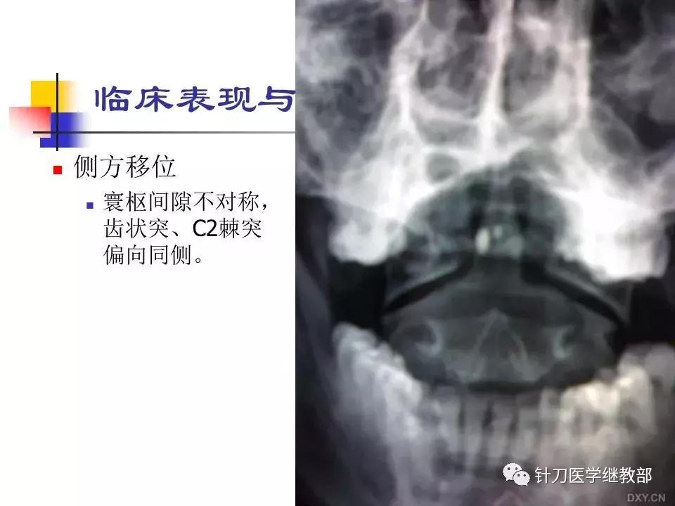 椎动脉型颈椎病错位了怎么治疗,颈椎寰枢关节错位复位手法