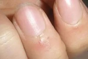 看指甲识健康,从指甲看疾病的图片说明