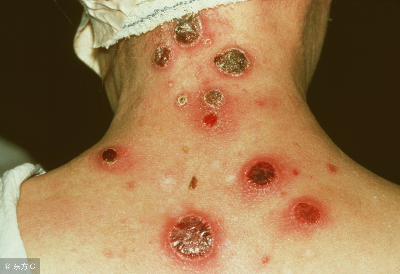 胎传梅毒会自愈吗,花两千块钱去除妊娠纹你愿意吗