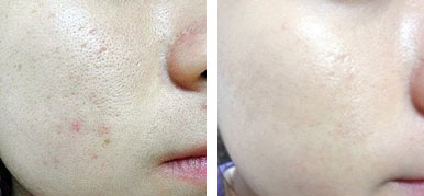 适合油皮粗大毛孔水乳,混油皮还敏感毛孔粗大怎么护肤