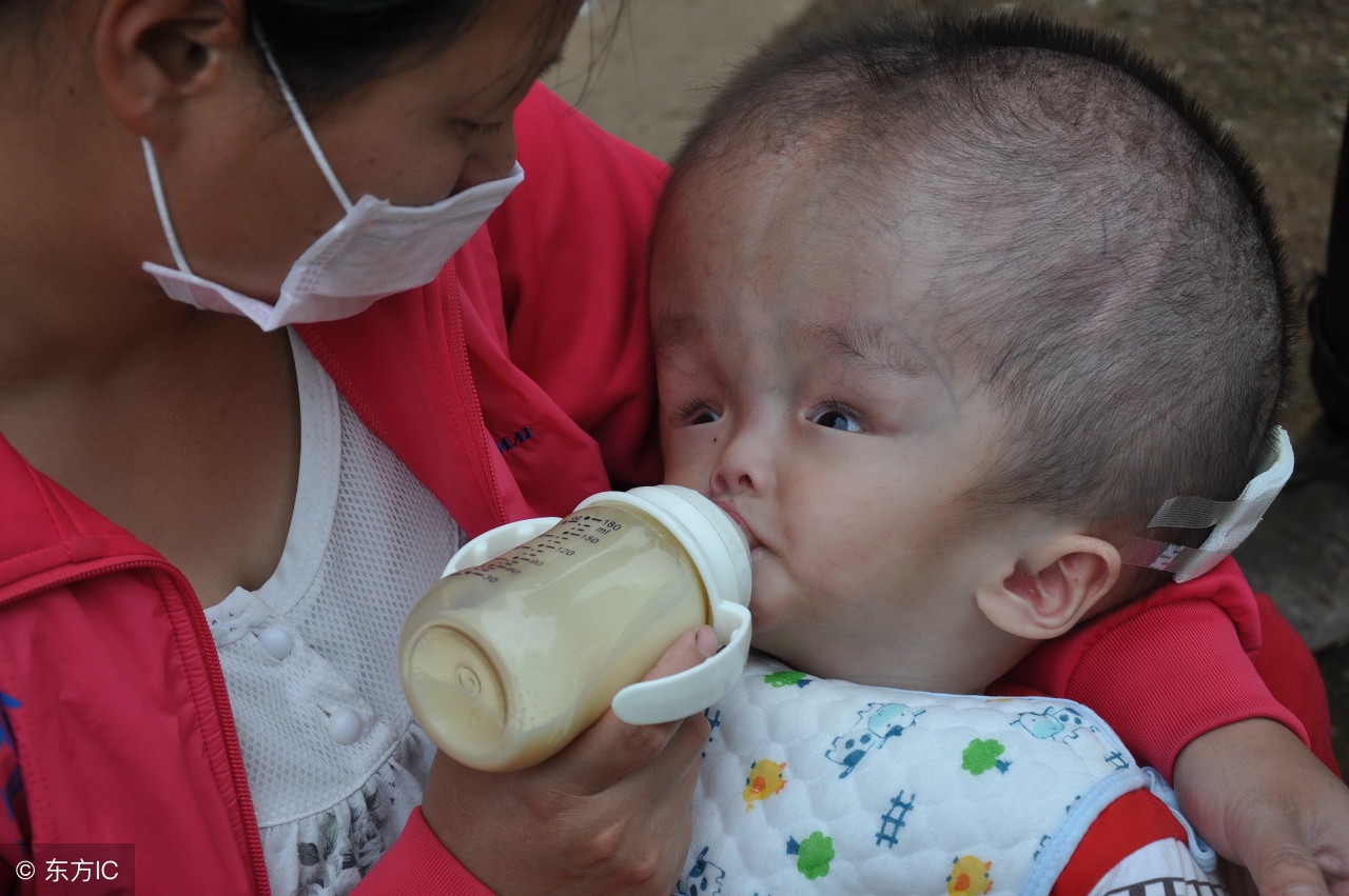 脑积水脱水疗法和全身疗法,脑积水引起的癫痫抽搐能活多久