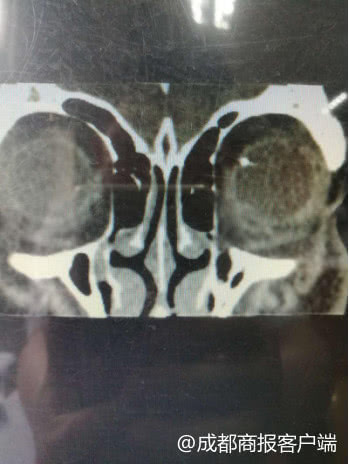 右眼被铁屑砸中后失明算重疾病吗,铁屑进了眼睛不取出来能恢复吗