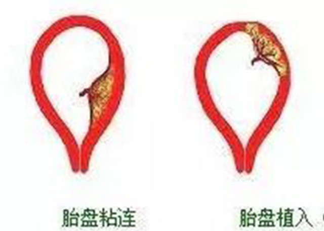 疤痕子宫可以生三胎剖宫产吗,一次剖宫产会有两道疤痕吗