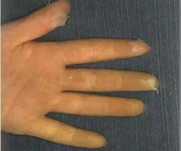 夏季猩红热高发家有娃娃要当心,为什么猩红热高发于儿童