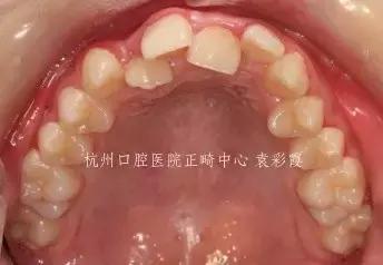 原来，上牙盖住下牙太多，也对牙齿有伤害！该怎么矫正？