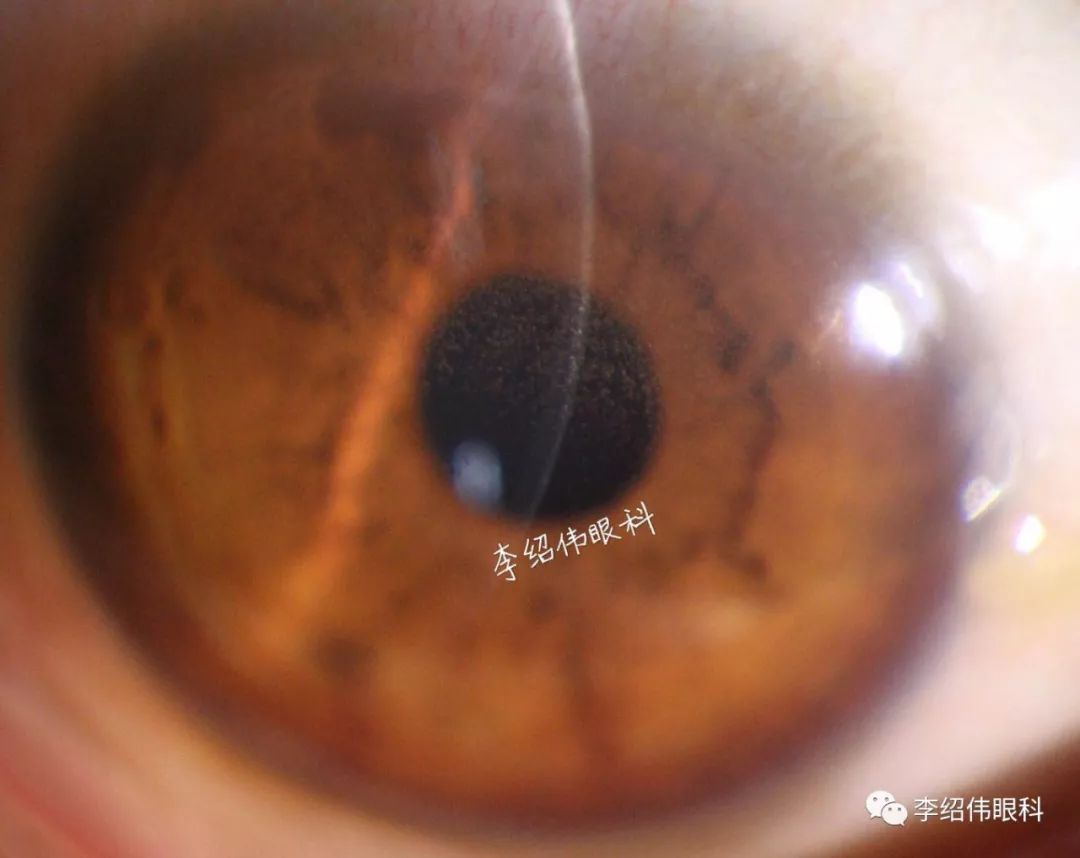 李绍伟爱尔眼科手术案例,李绍伟爱尔眼科
