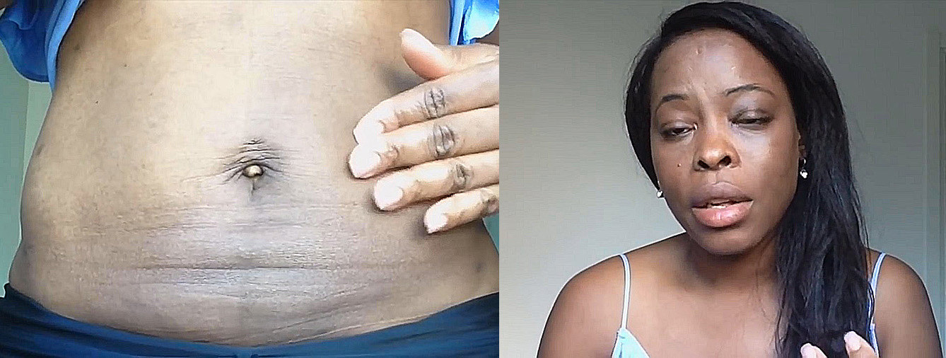 吸脂减肥前后对比图片,吸脂减肥全部过程视频术后