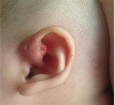 宝宝耳朵有个小洞是什么福气,孩子耳朵上有个富贵洞