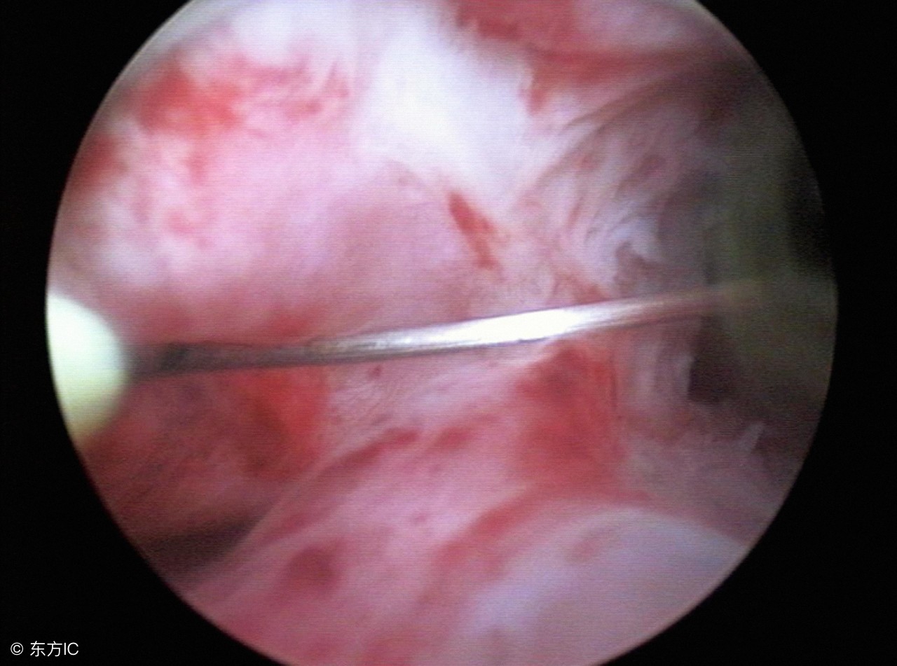 宫腔积液是怎么造成的？检查出宫腔积液需要治疗吗？
