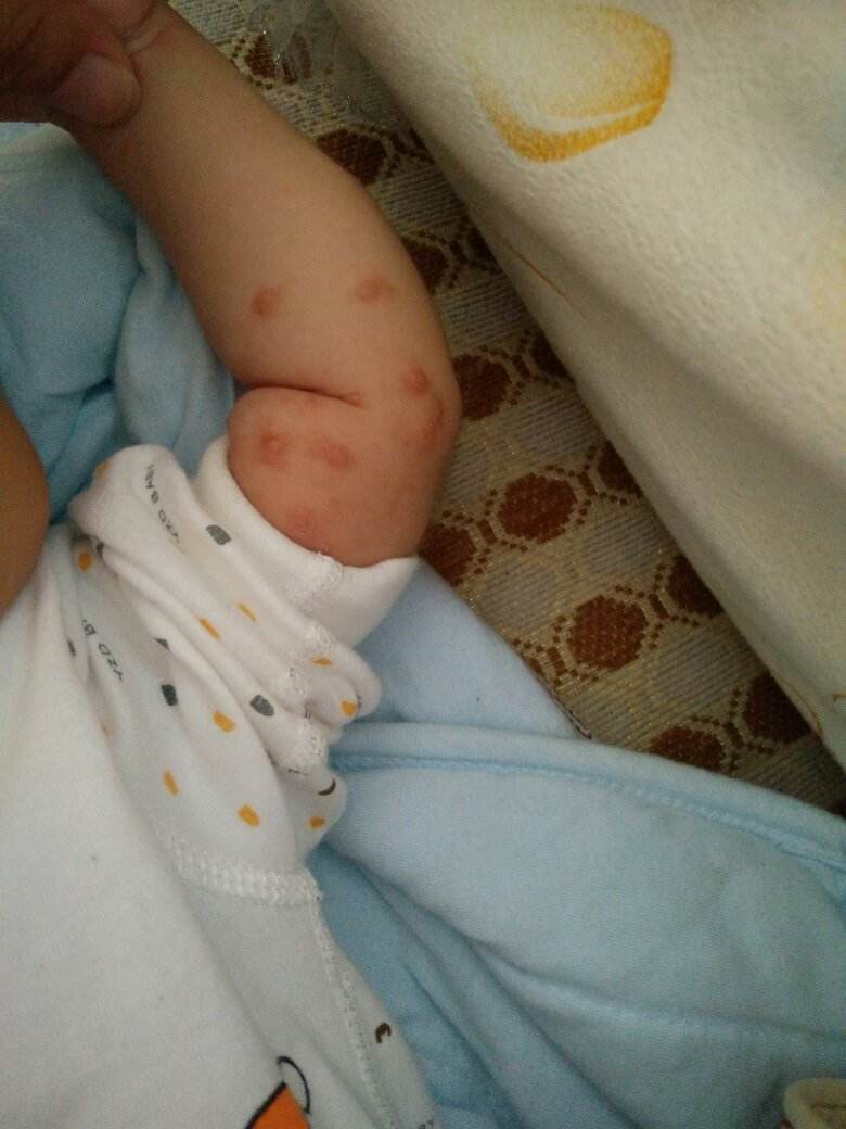 宝宝被蚊虫咬了几天了红肿硬块疼,婴幼儿蚊虫叮咬性皮炎破溃怎么办