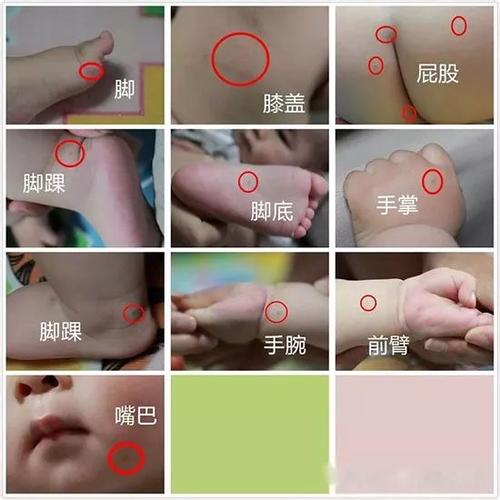 喉咙有两个疱疹发烧是手足口病吗,发烧引起的疱疹是疱疹性咽峡炎吗